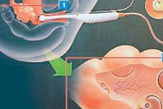 未怀过孕输卵管也可能堵塞，堵塞原因主要有以下这些